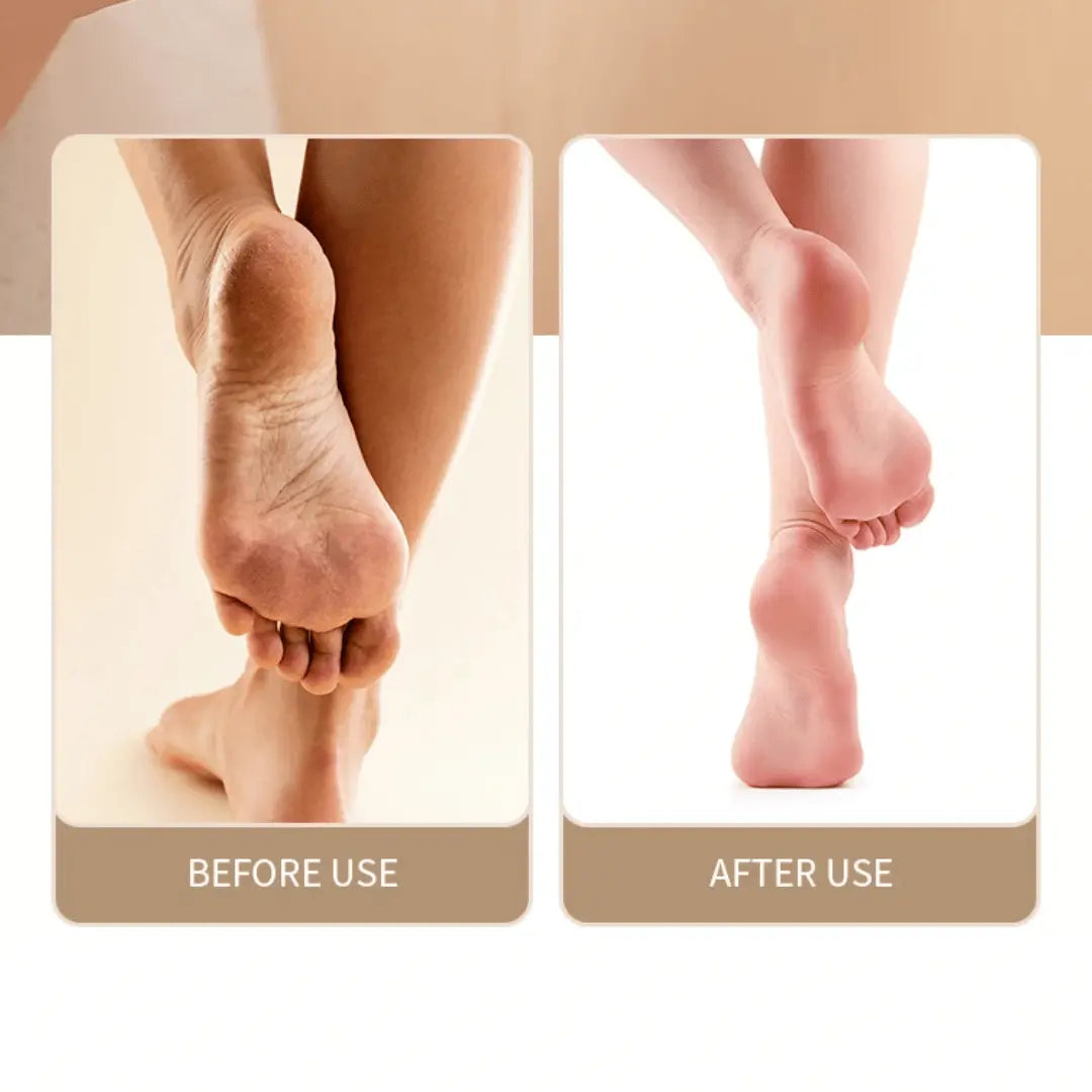 Before and after comparison showing smooth feet results achieved with SmoothStep rechargeable foot file