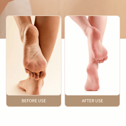 Before and after comparison showing smooth feet results achieved with SmoothStep rechargeable foot file